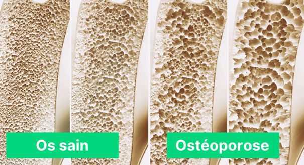 Os sain & ostéoporose 